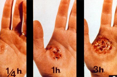 Simulation of the evolution of an injury caused by chemicals on a 3 hours period.