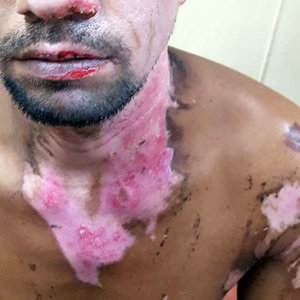 Chemical burns of the skin
